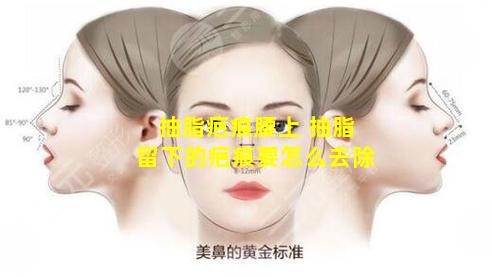 抽脂疤痕腰上 抽脂留下的疤痕要怎么去除
